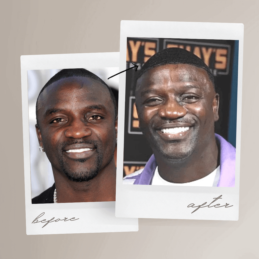 Akon Spent 7 500 Dollars On Hair Transplant In Turkey Estenbul Health