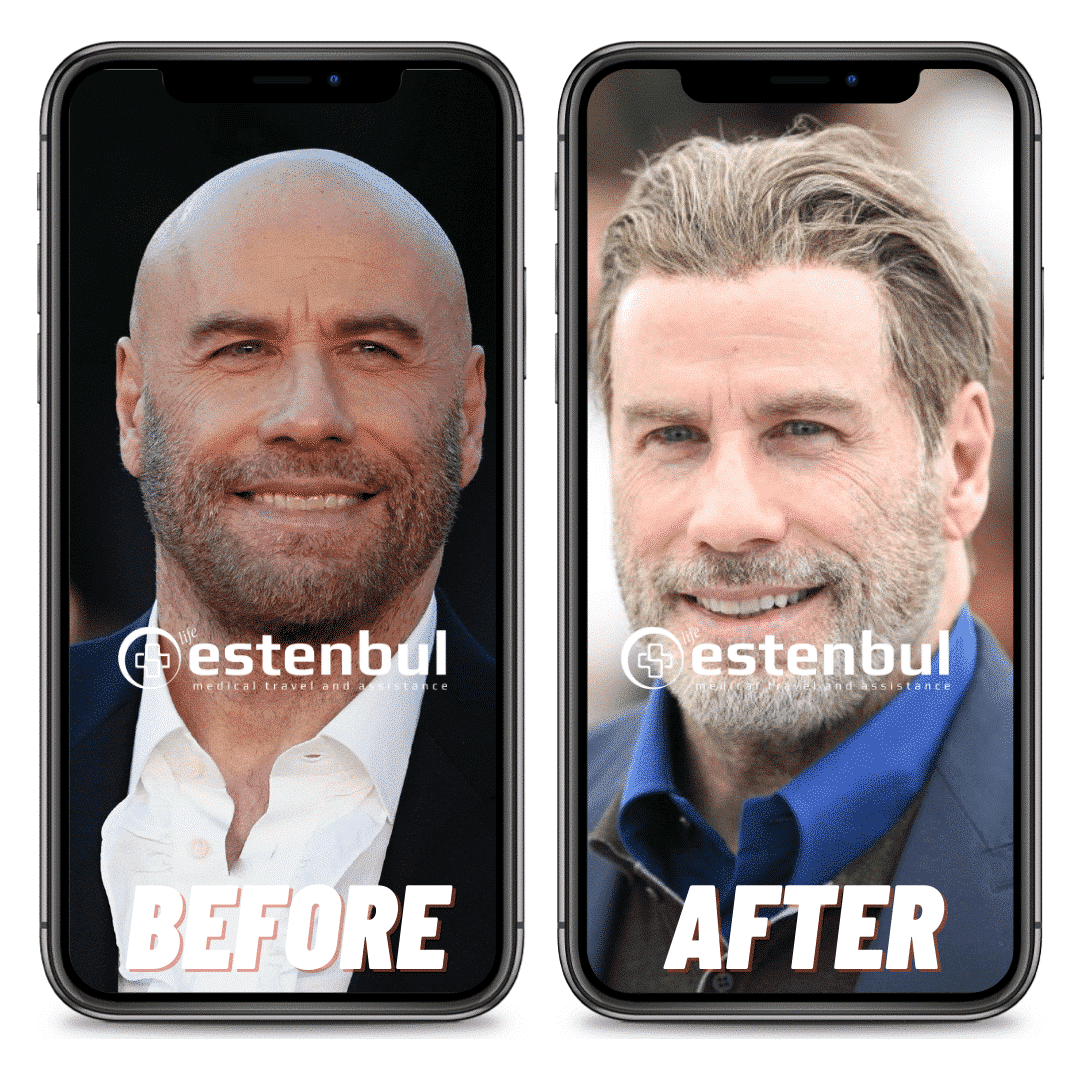 Celebrity Hair Transplant Transformations Before And After Comparison