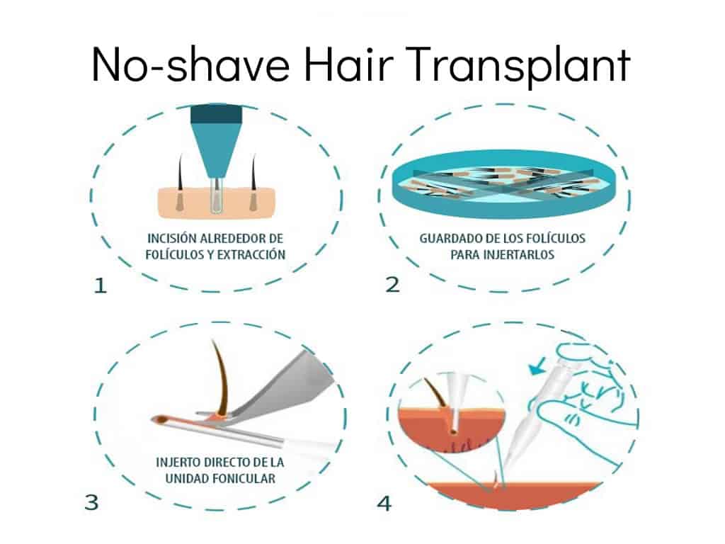 No-shave Hair Transplant