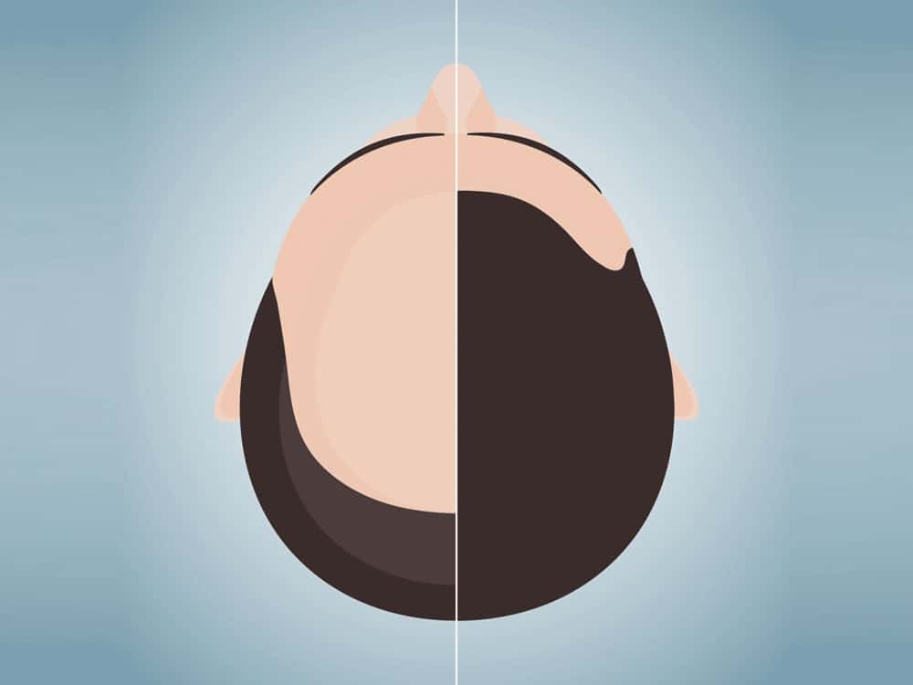 how is hair transplant operation is applied?