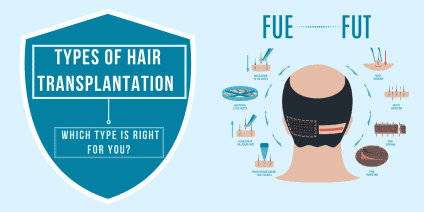 What are the Types of Hair Transplant