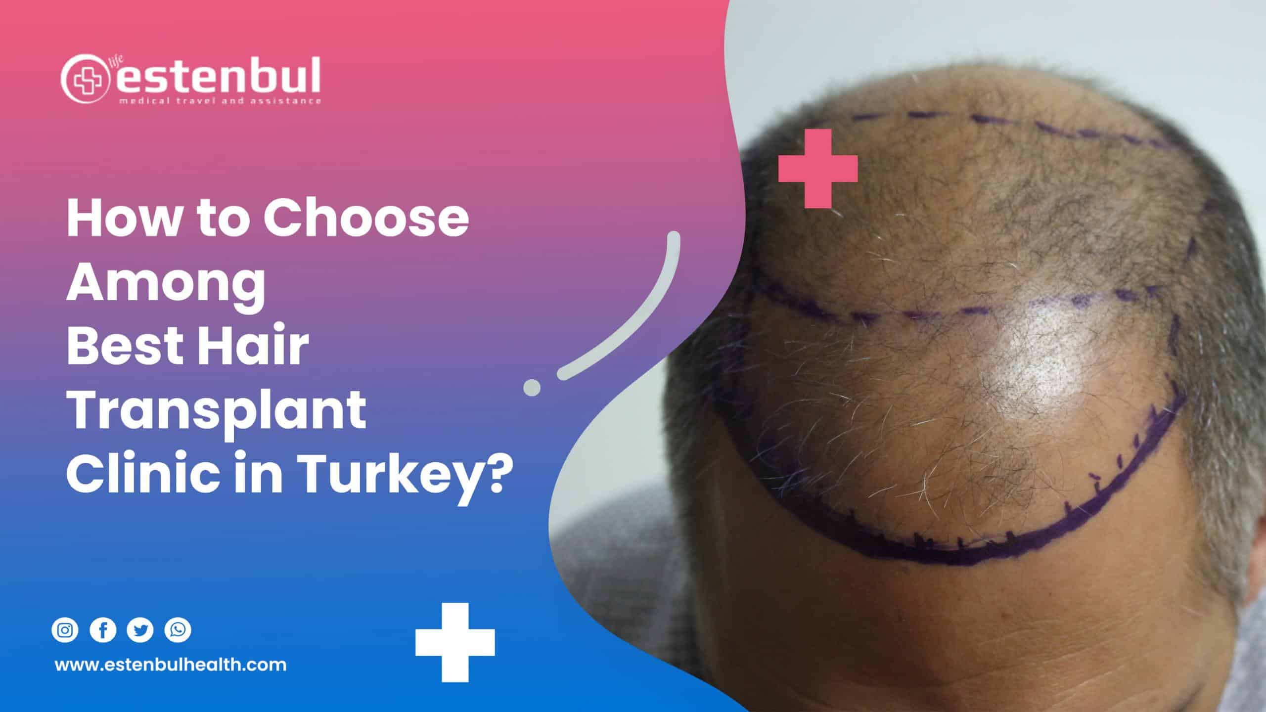 how to choose among best hair transplant clinic in turkey