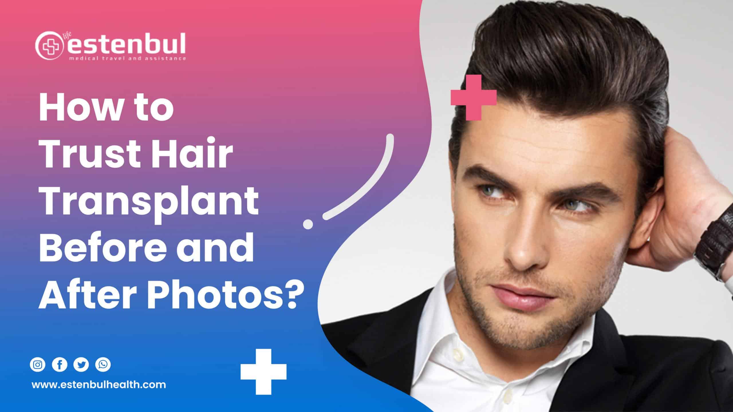 how to trust hair transplant before and after photos