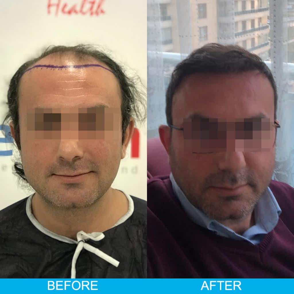 Hair Transplant Result Turkey
