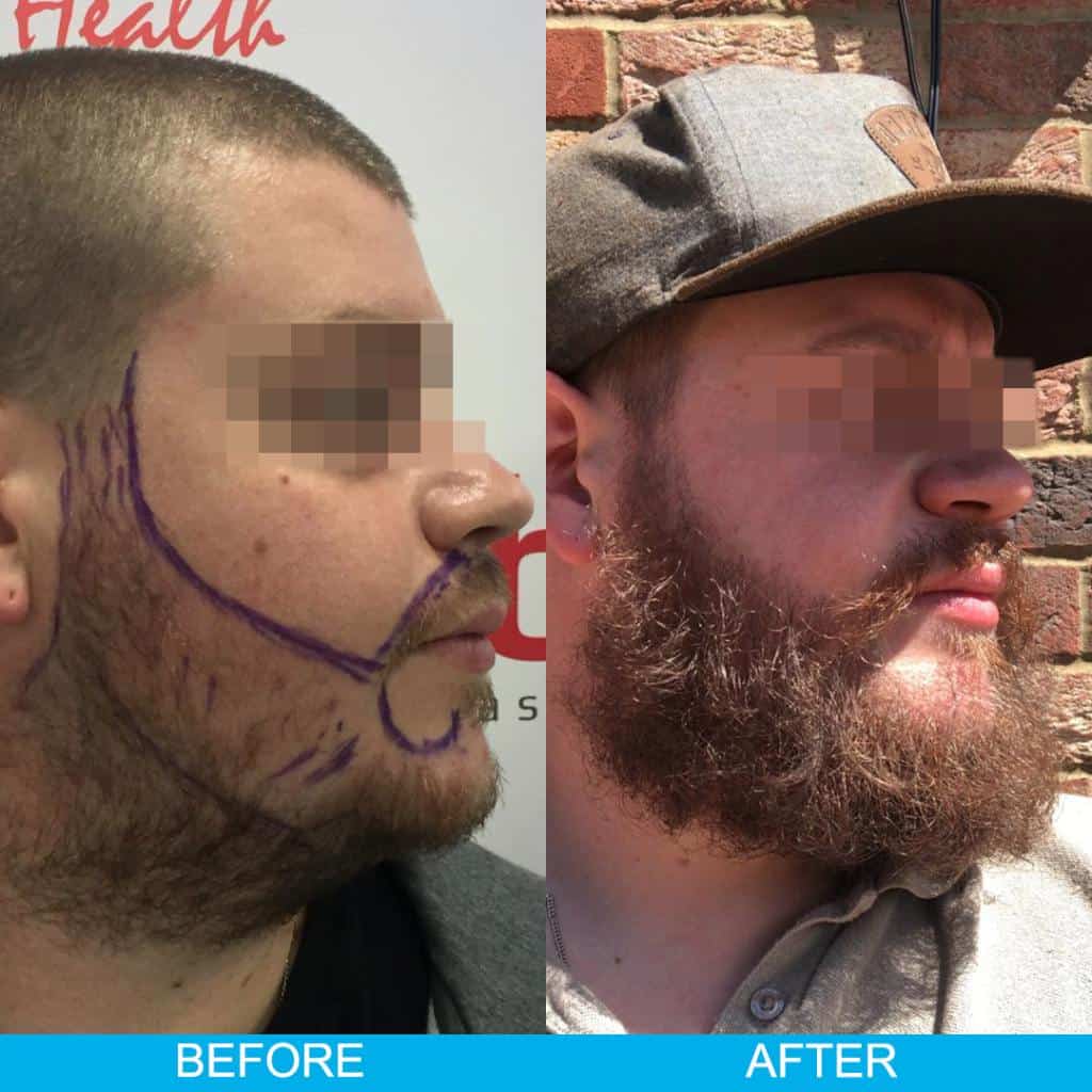 Beard Transplant Result Turkey
