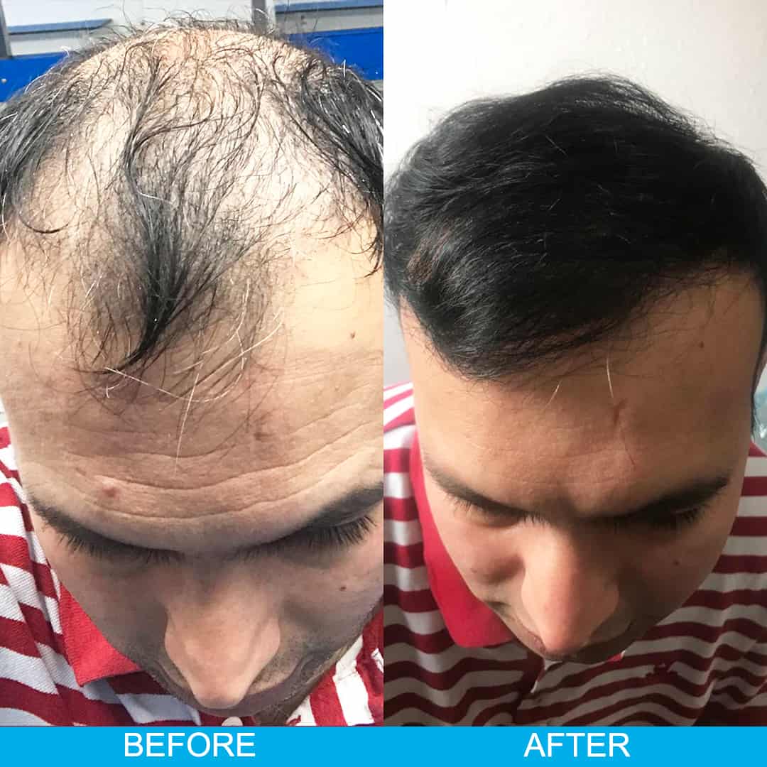 the-facts-about-hair-transplant-in-turkey-dr-arslan-musbeh-revealed