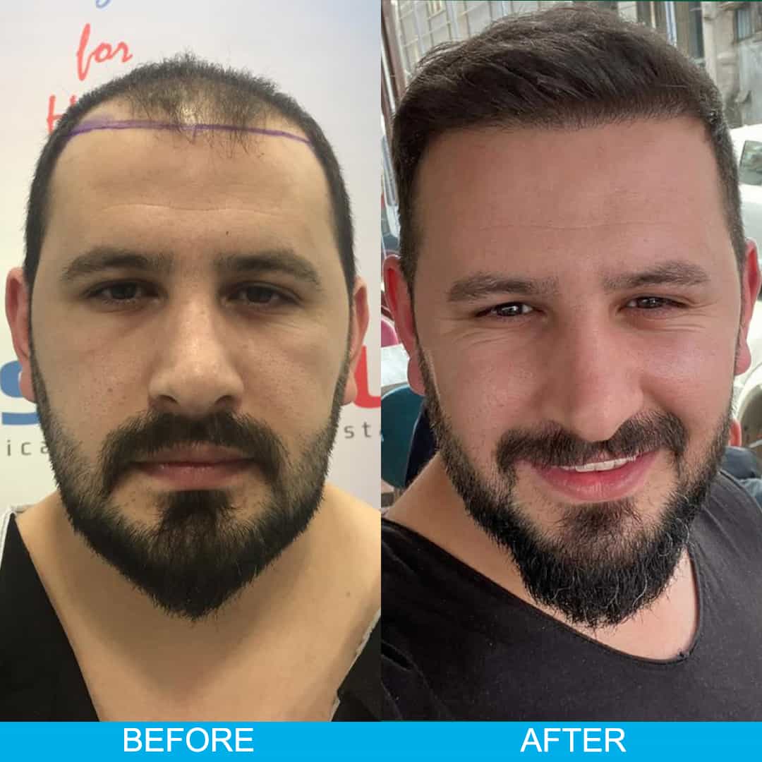 hair-transplant-result-turkey-estenbul-health