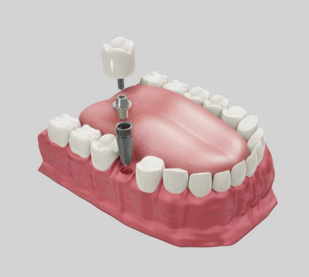 Dental Implant in Turkey Istanbul