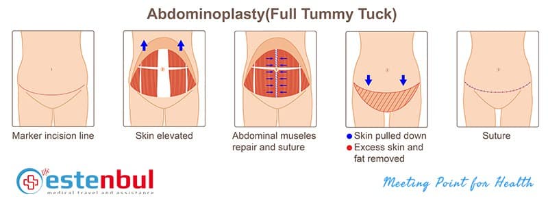 Abdominoplasty Tummy Tuck in Turkey Istanbul