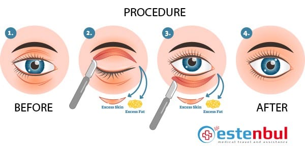 Eyelid Surgery Process
