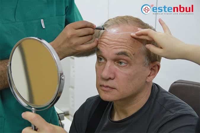 Best Hair Transplant in Turkey Istanbul | Estenbul Health