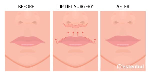 Lip Lift Surgery Before After