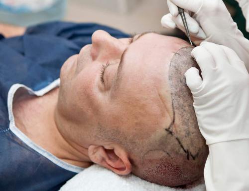 What Is The Success Rate of Hair Transplant?