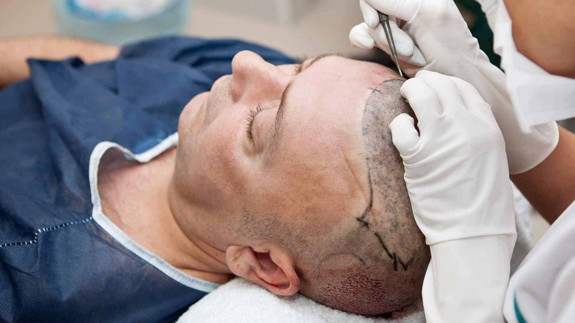 success rate on hair transplant