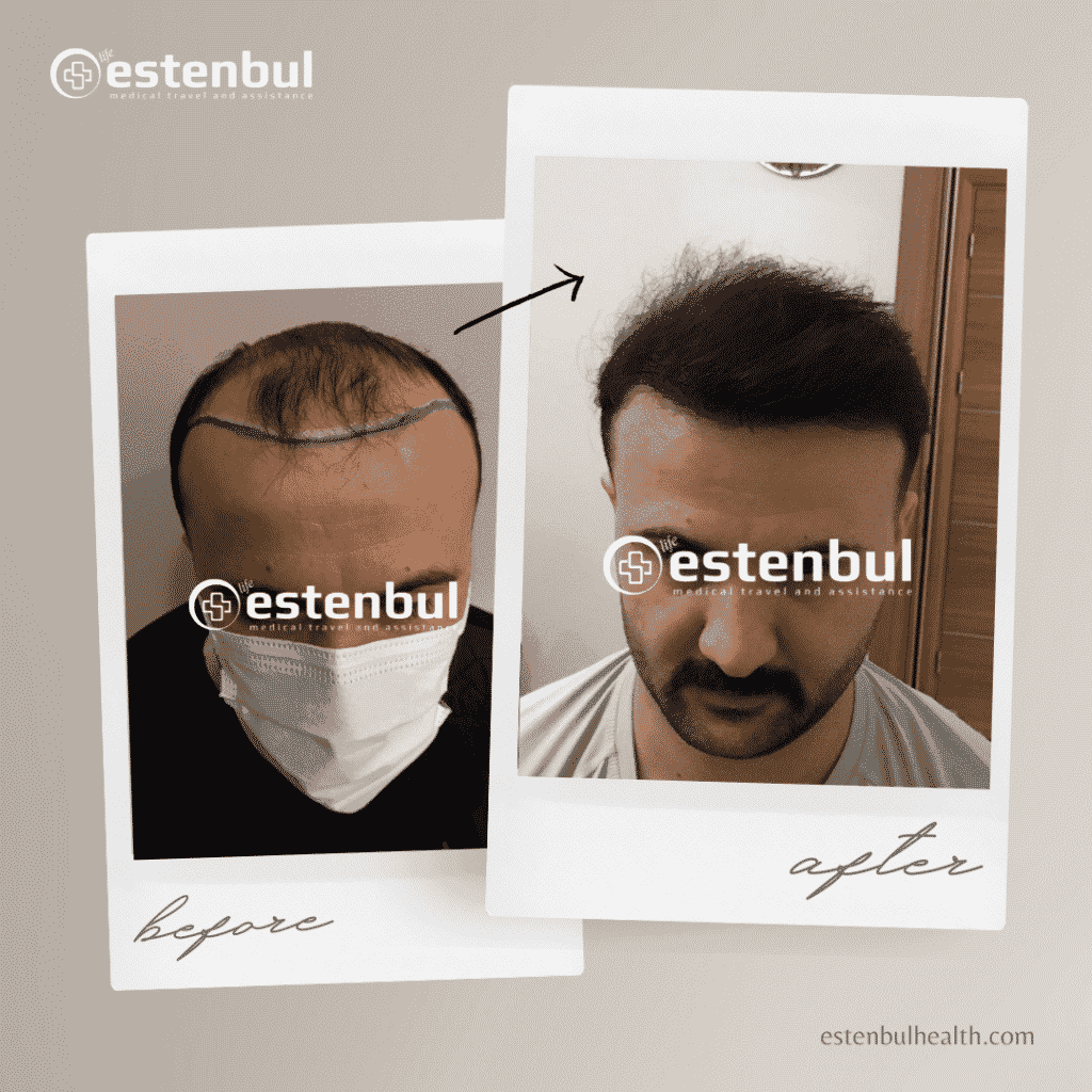 hair transplantation in turkey before after results 2