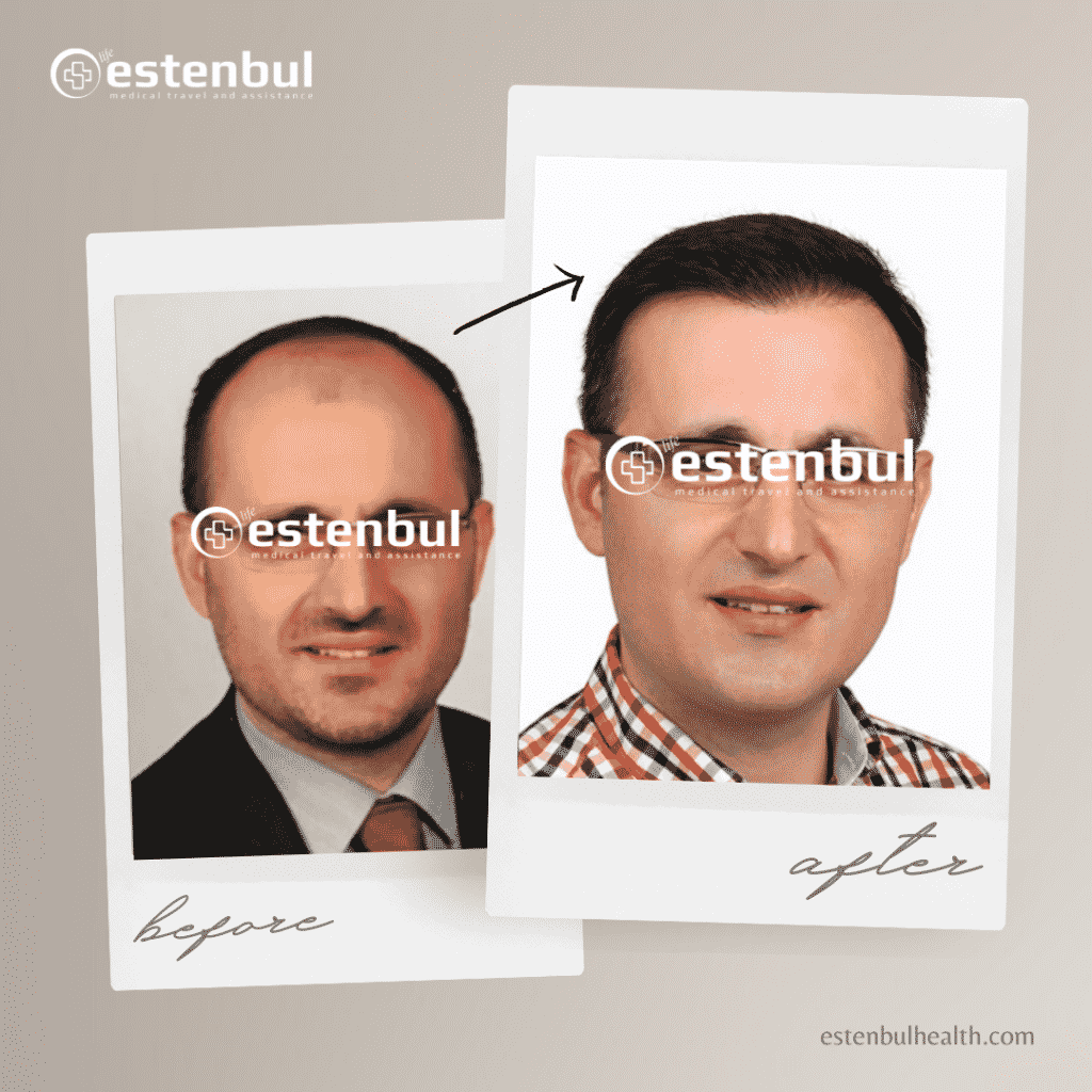hair transplantation in turkey before after results 3