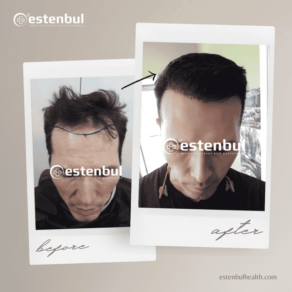 hair transplantation in turkey before after results 4