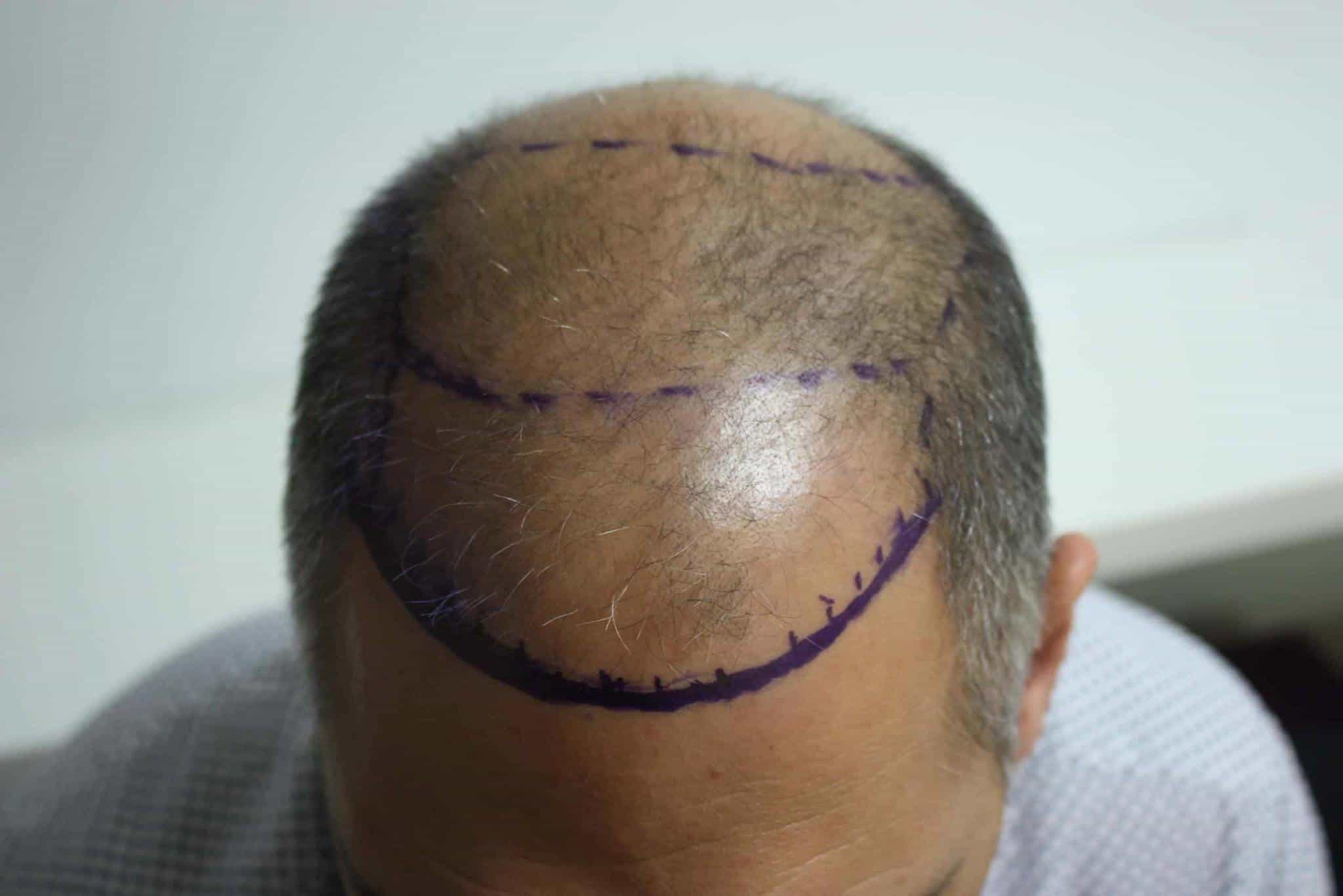Steps for Direct Hair Implantation (DHI) | Estenbul Health