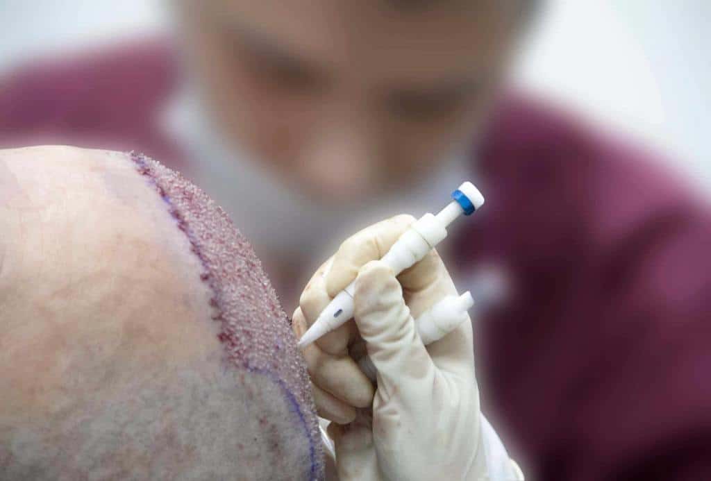 DHI Hair Transplantation application