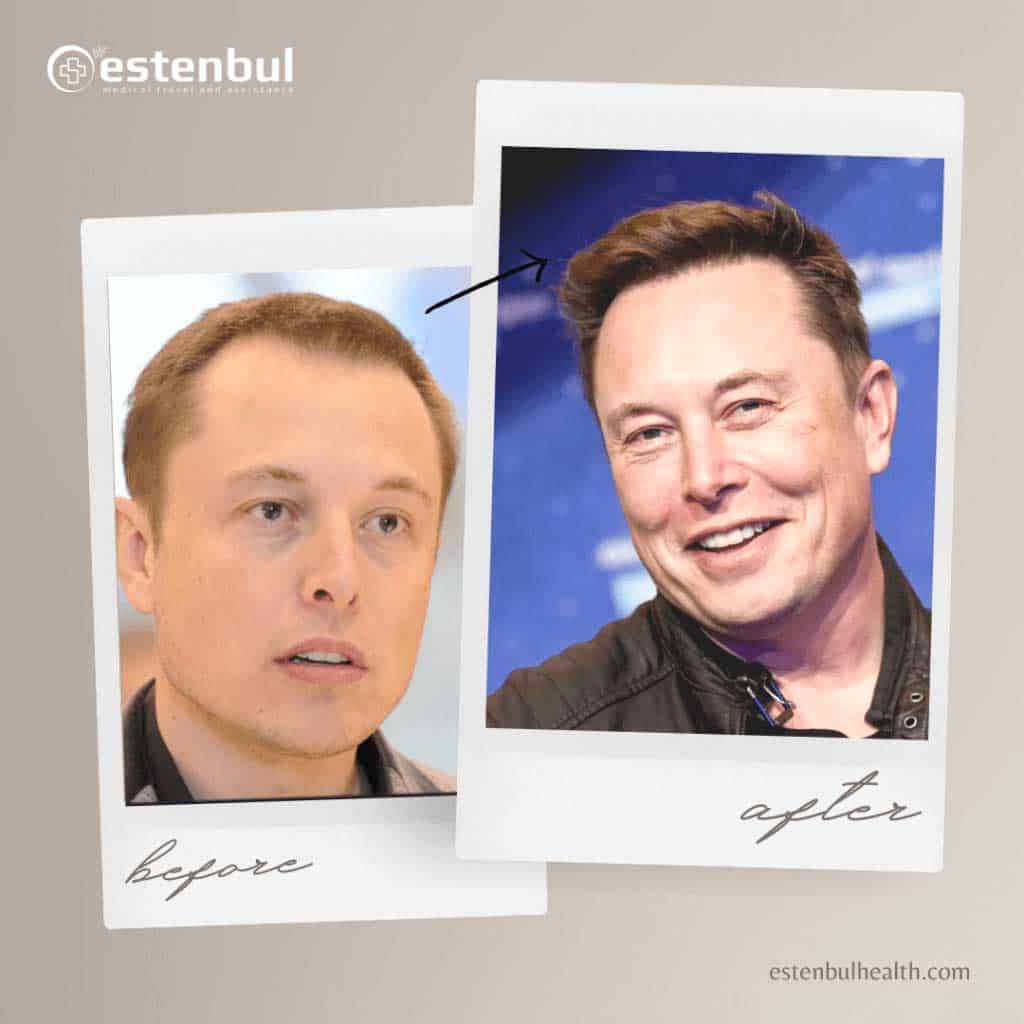 Elon Musk Hair Transplant Result