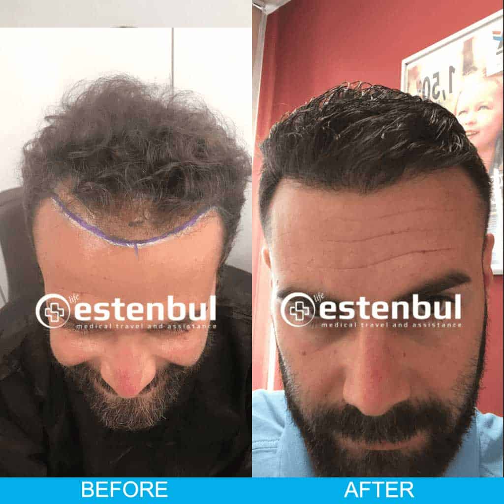 hair transplantation in turkey before after results