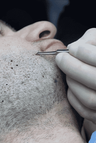 Beard Transplant in Istanbul