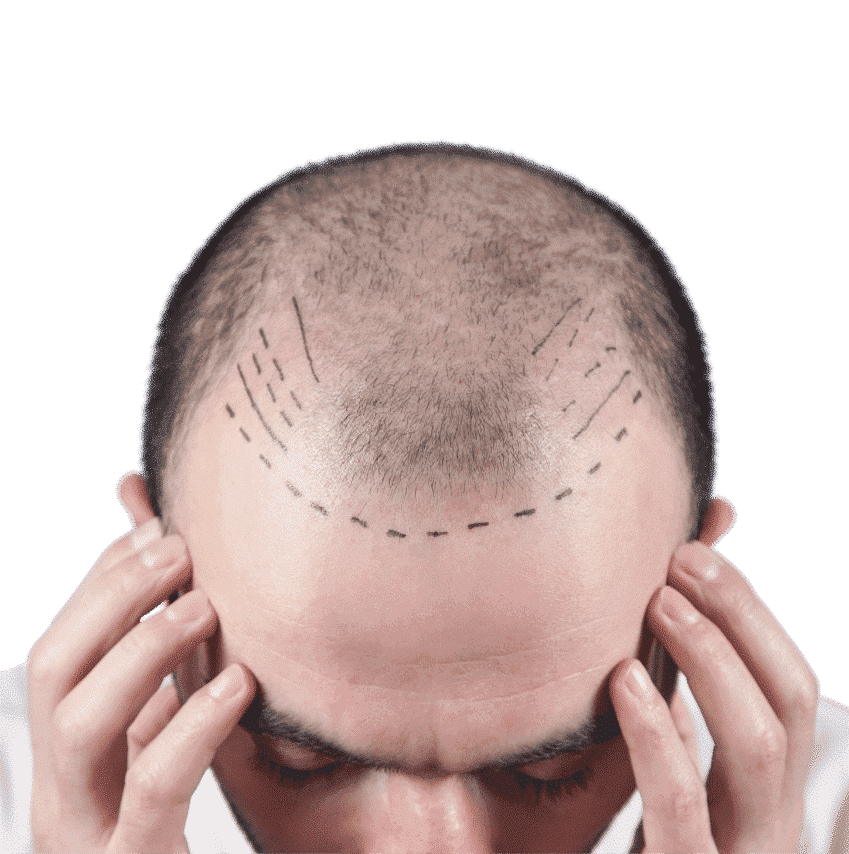 Free Consultation for Hair Transplant
