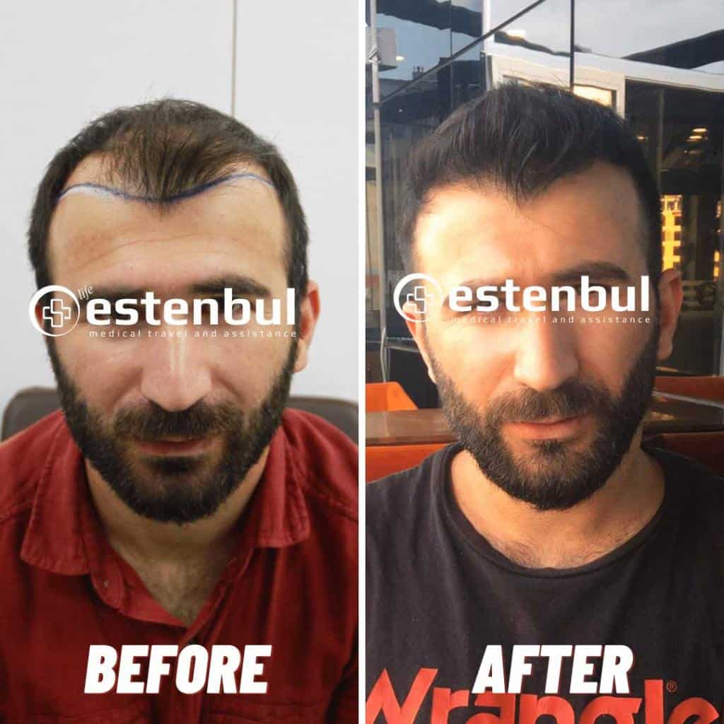 4500 Greffes de Cheveux Avant et Après