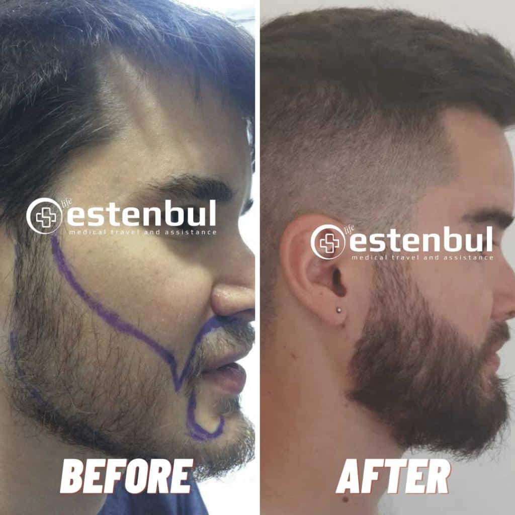Greffe de Barbe Turquie Résultats Avant et Après