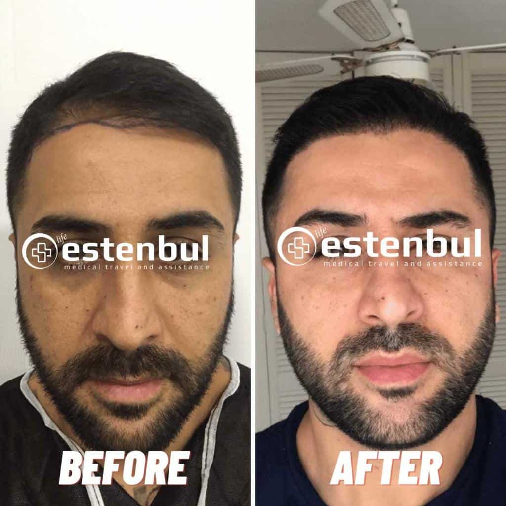 4000 Greffes de Cheveux Avant et Après