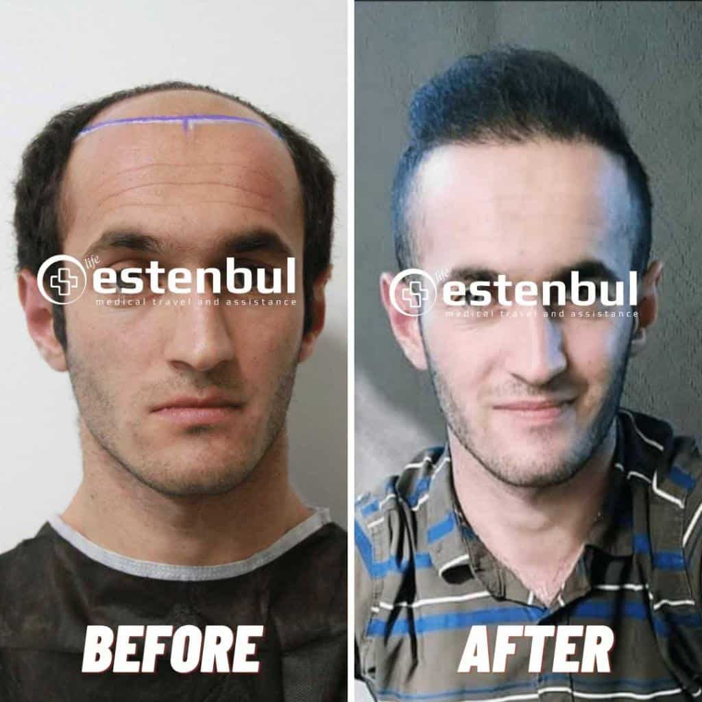 4000 Greffes de Cheveux Avant et Après