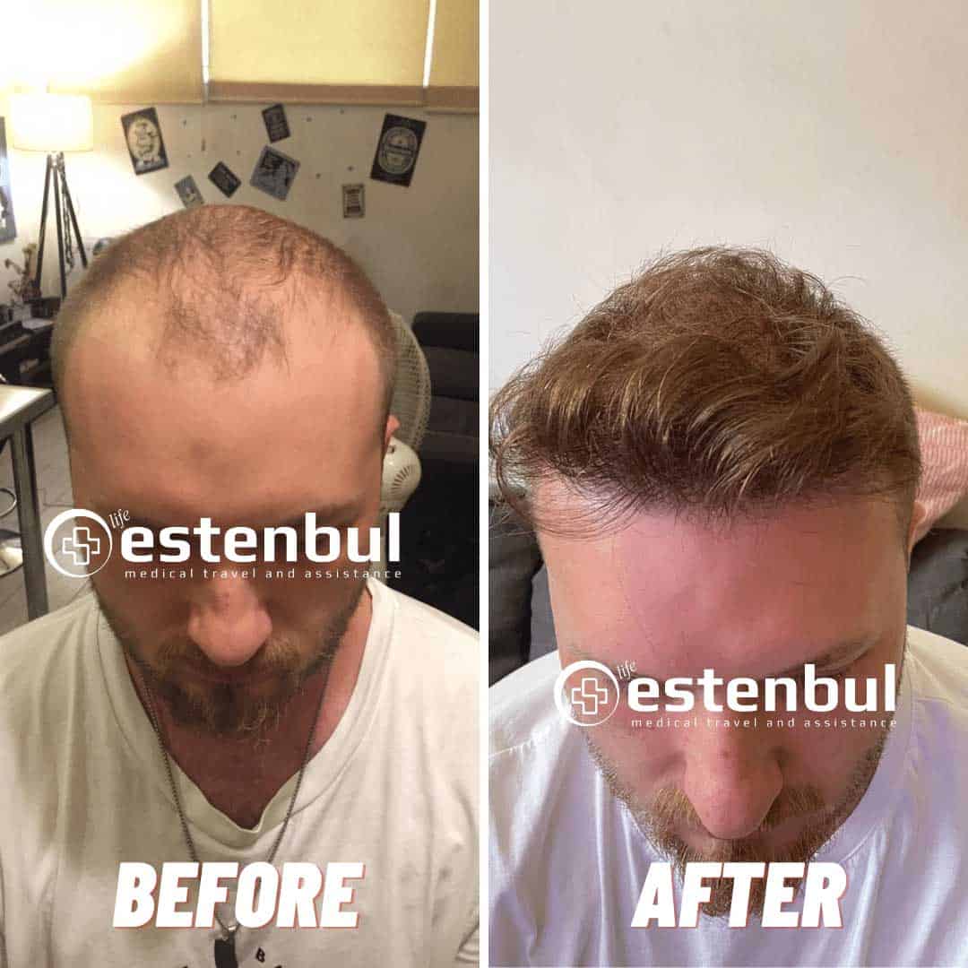 8000 Hair Grafts Before and After - Hair Transplant Turkey