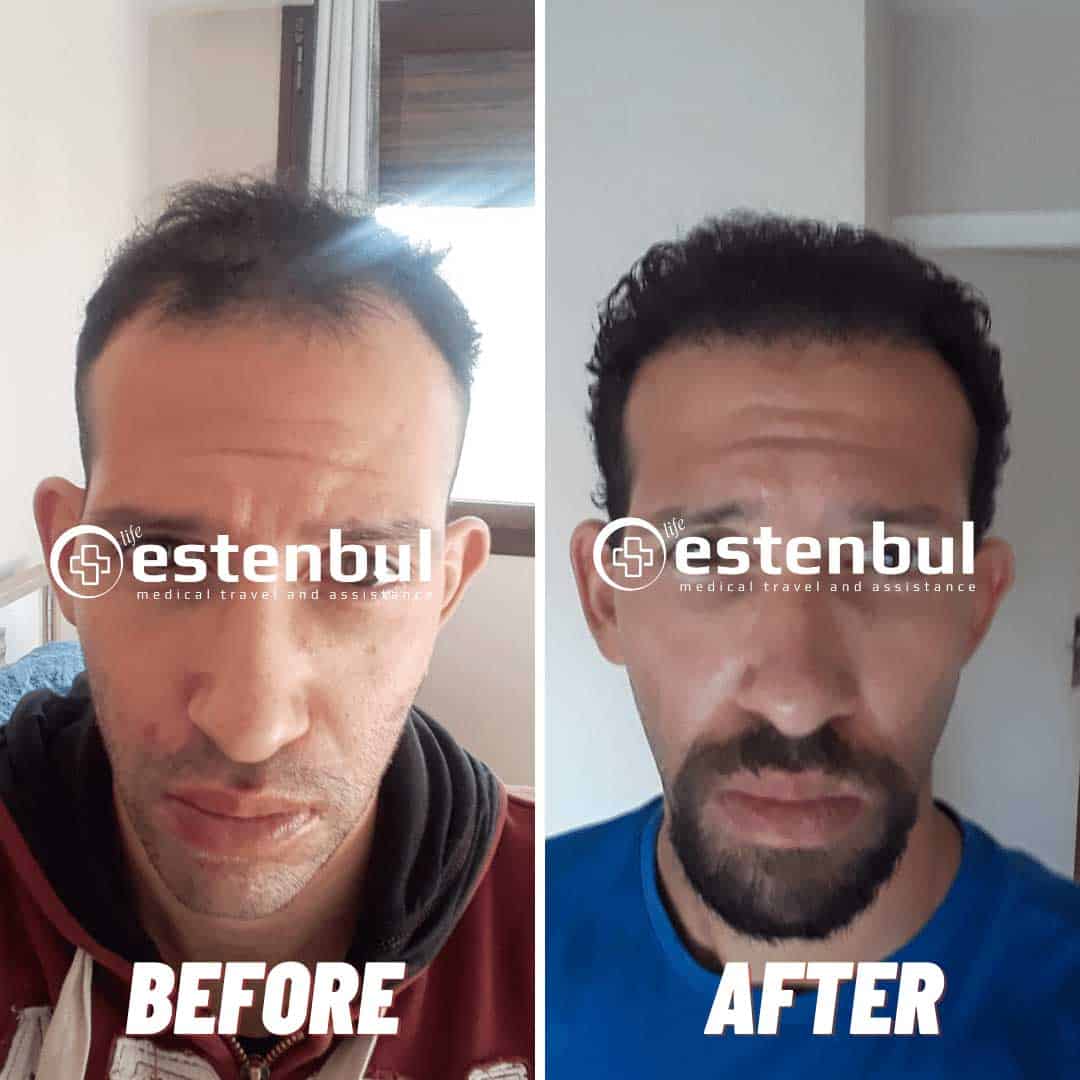 5000 Hair Grafts Before and After