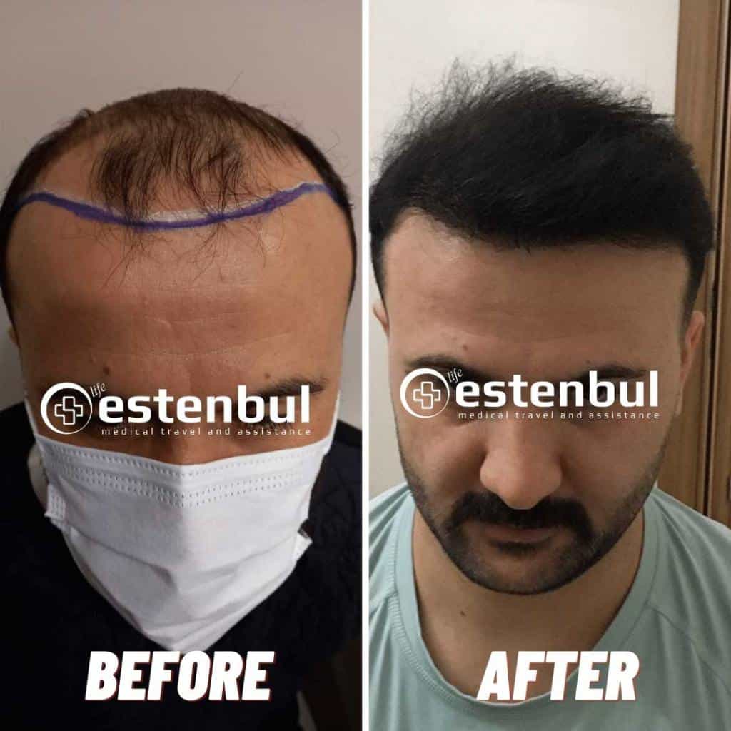5000 Hair Grafts Before and After Hair Transplant Turkey