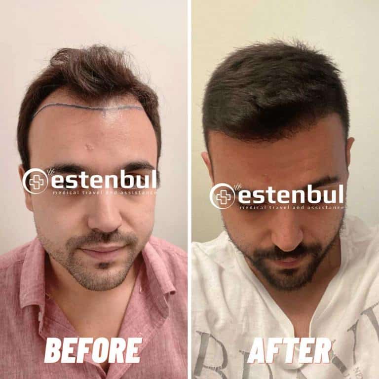 Best Hair Transplant In Turkey Istanbul Estenbul Health