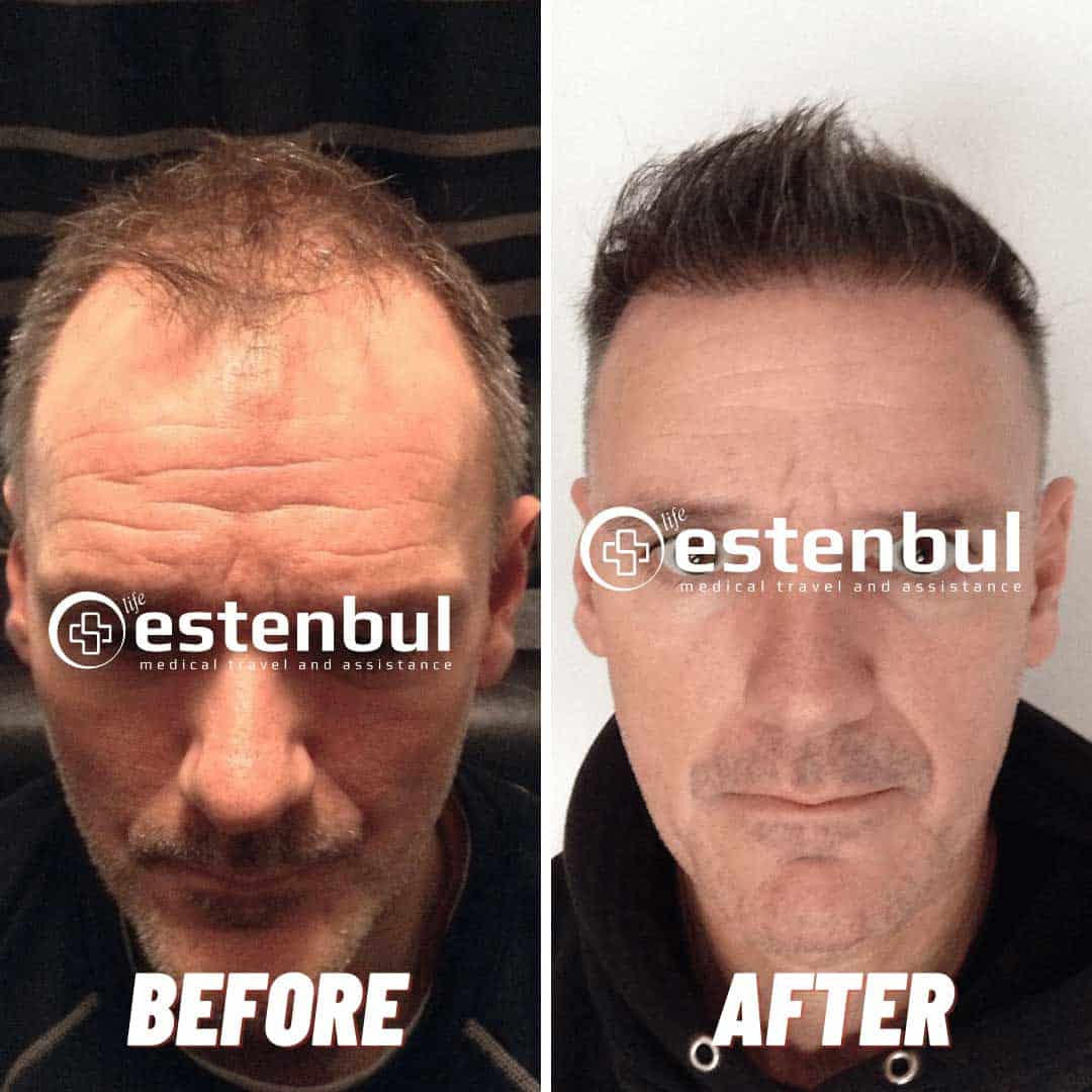 Hair Transplant Turkey Before and After