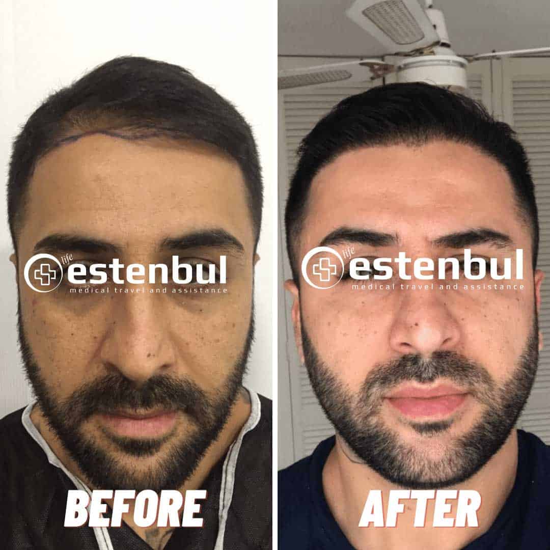 4000 Hair Grafts Before and After