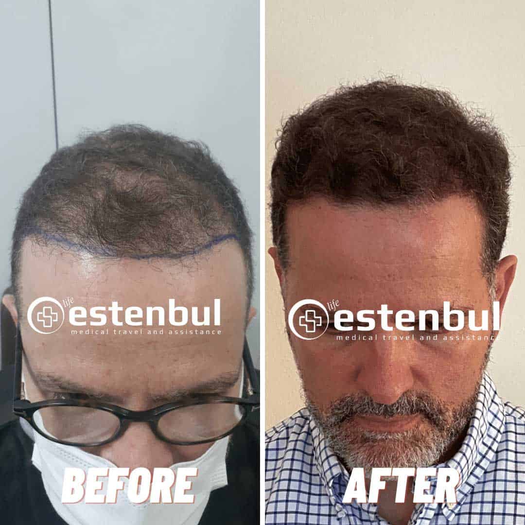 4000 Hair Grafts Before and After