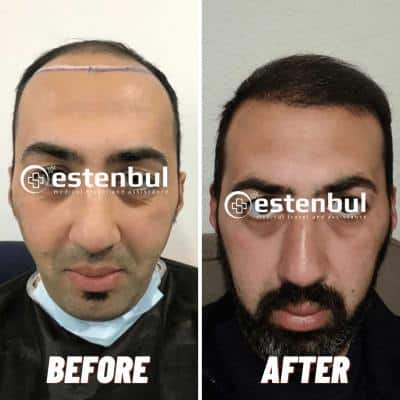 Hair Transplant Turkey Before And After Results | Estenbul Health