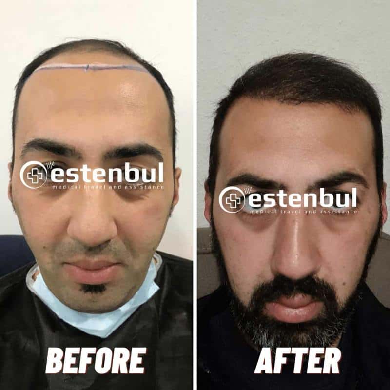 Best Hair Transplant In Turkey Istanbul Estenbul Health