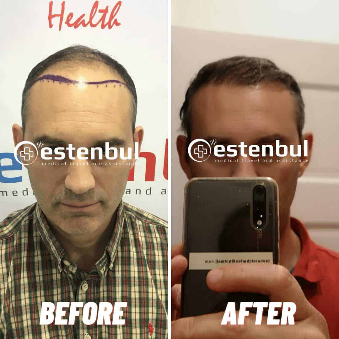 4500 Hair Grafts Before and After Hair Transplant Turkey