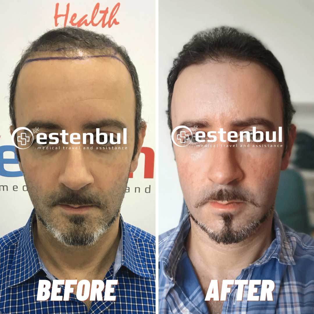 20 DAY LATER 5000 GREFT FUE METHOD Amazing change in 20 days. #hair # hairtransplant #hairstyle #medic #aesthetic #operation #turkey… | Instagram