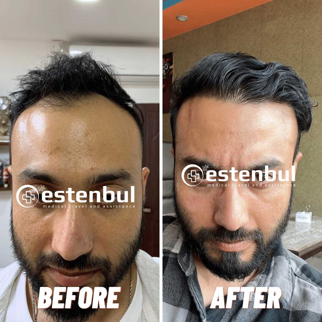 4000 Hair Grafts Before and After Hair Transplant Turkey
