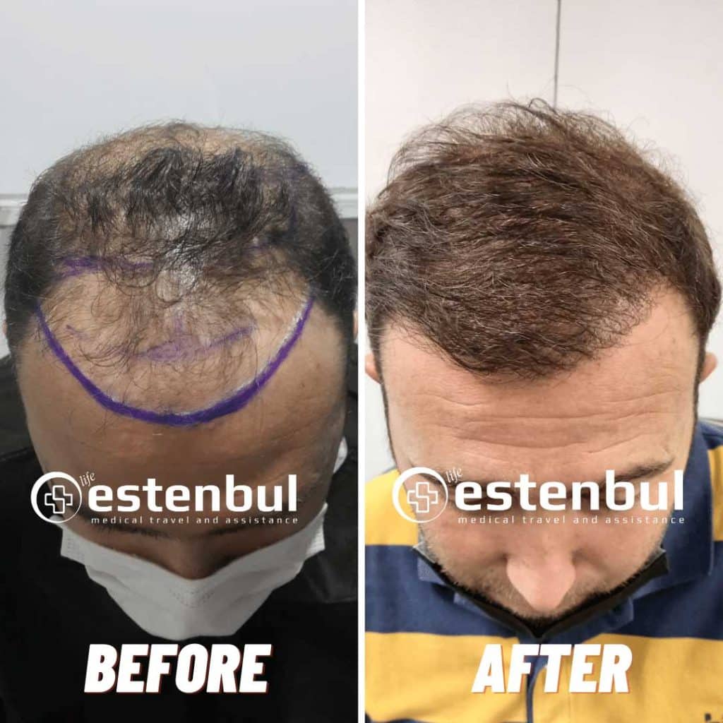 hair transplant turkey before and after