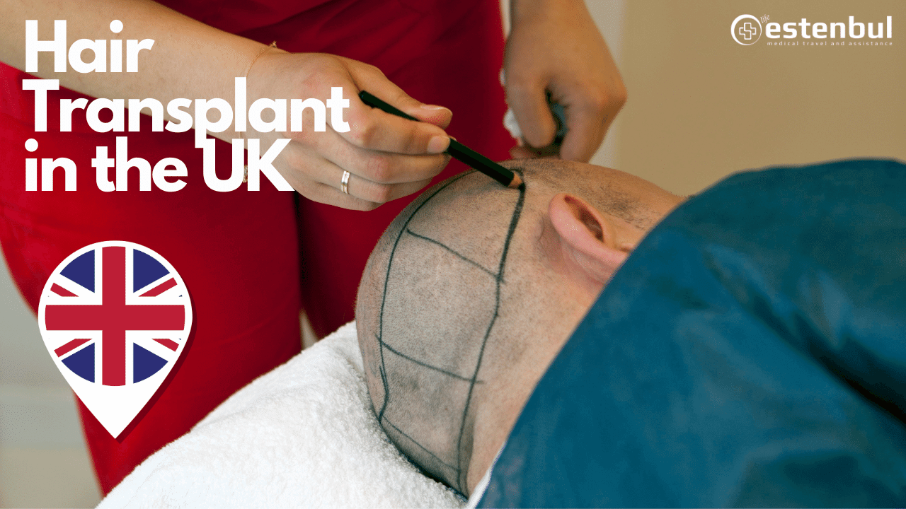 Hair Transplant in the UK
