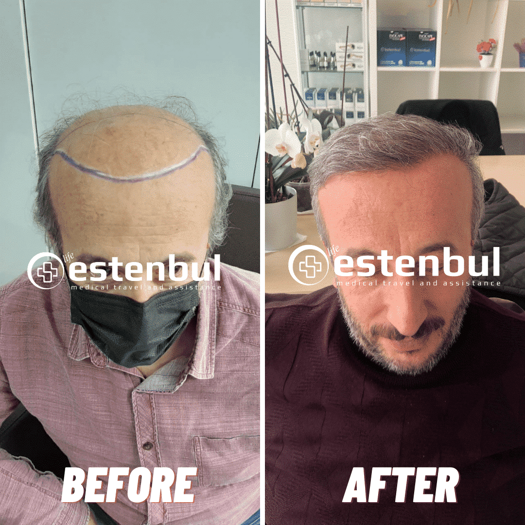 9000 Hair Grafts Before and After Hair Transplant Turkey