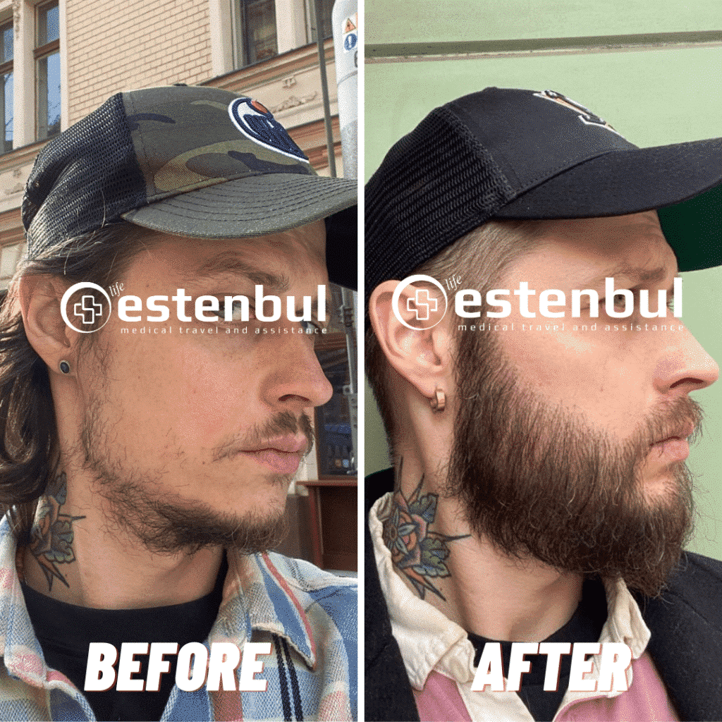 3500 Hair Grafts Beard Transplant Before and After