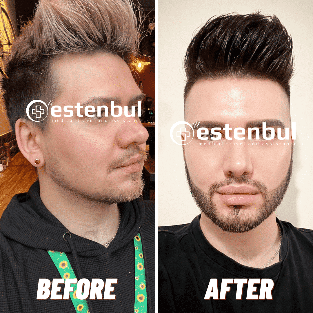 3000 Hair Grafts Beard Transplant Before and After