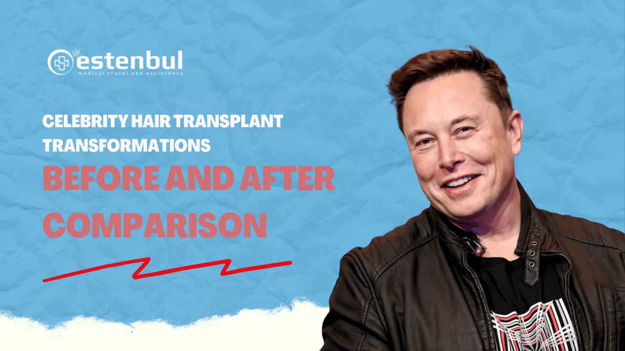 Celebrity Hair Transplant Transformations - Before and After Comparison