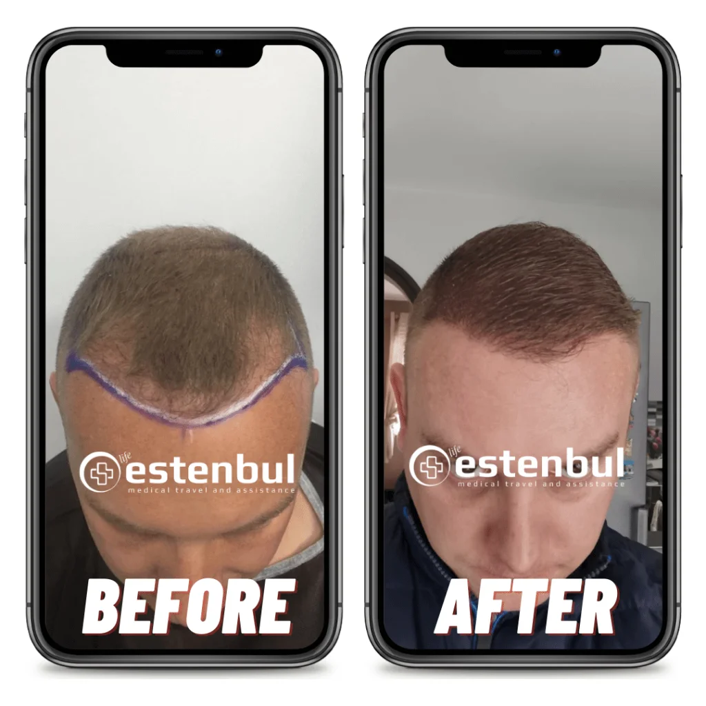 DHI Hair Transplant Results